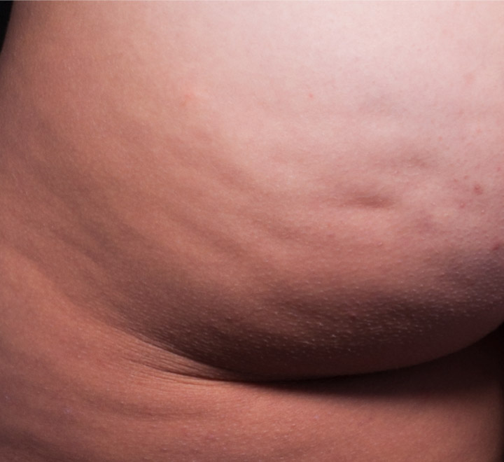 photo of cellulite, before Cellfina