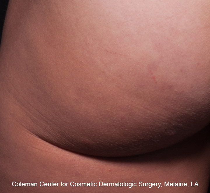 photo of cellulite, 3 years after Cellfina